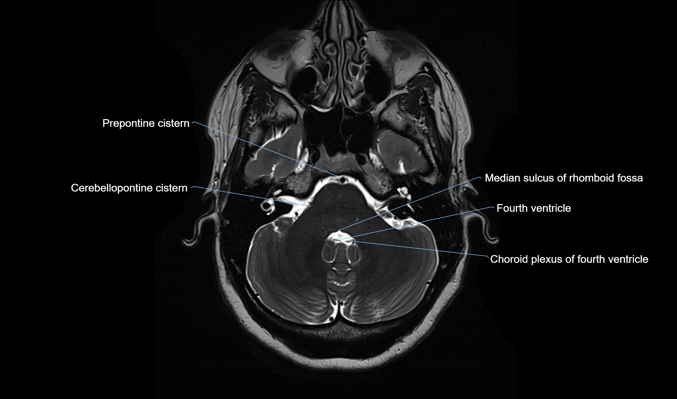 Brain cisterns  and ventricles  axial anatomy 3T MRI image-img-00001-00012.webp